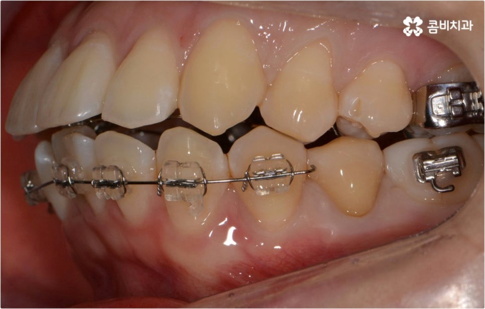 돌출입 치아교정 부모와 아이가 함께 알아봐요 관련 이미지 3