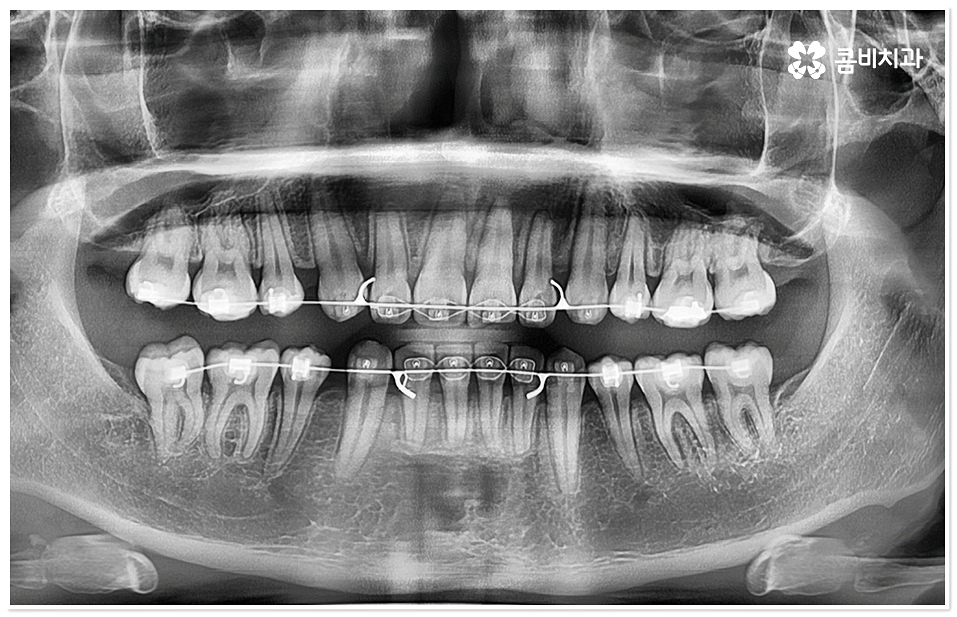 덧니치아교정 고려할 사항들은 관련 이미지 10