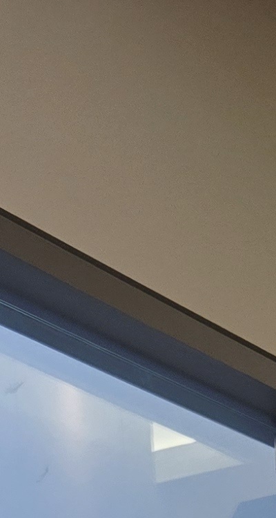 아말감 교체 레진 인레이 어떻게 대처하면 될까 관련 이미지 16