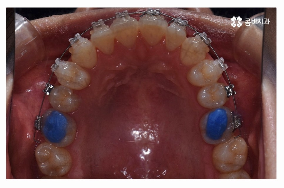 덧니교정 체계적으로 준비하려면 관련 이미지 11