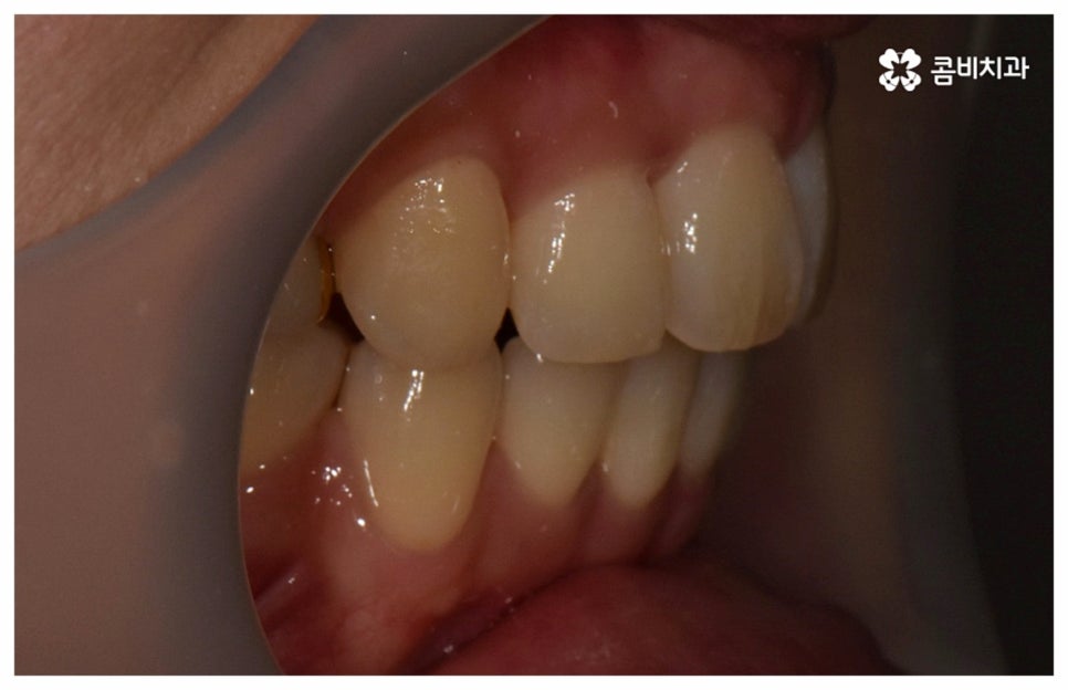 중년치아교정 원한다면 관련 이미지 16