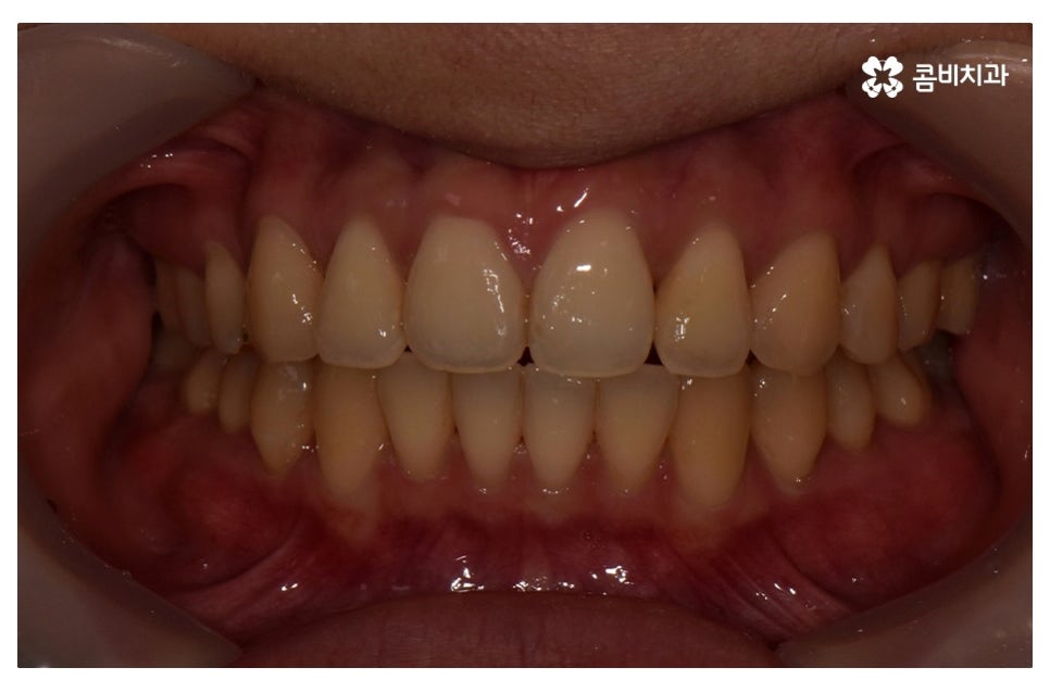 덧니교정 정확하게 알아보려면 관련 이미지 14