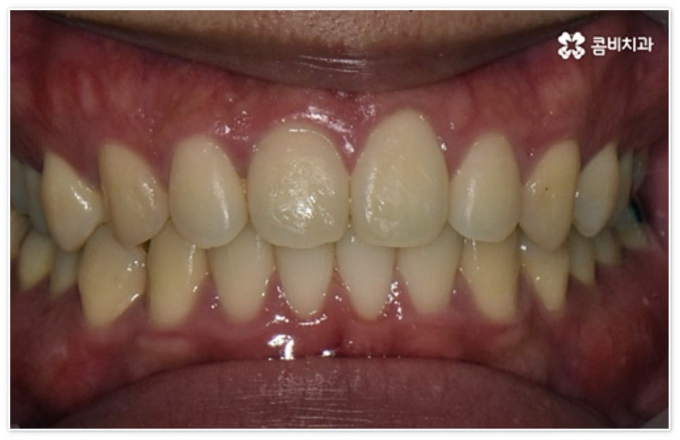 앞니 벌어짐 고치고 싶어요 관련 이미지 11