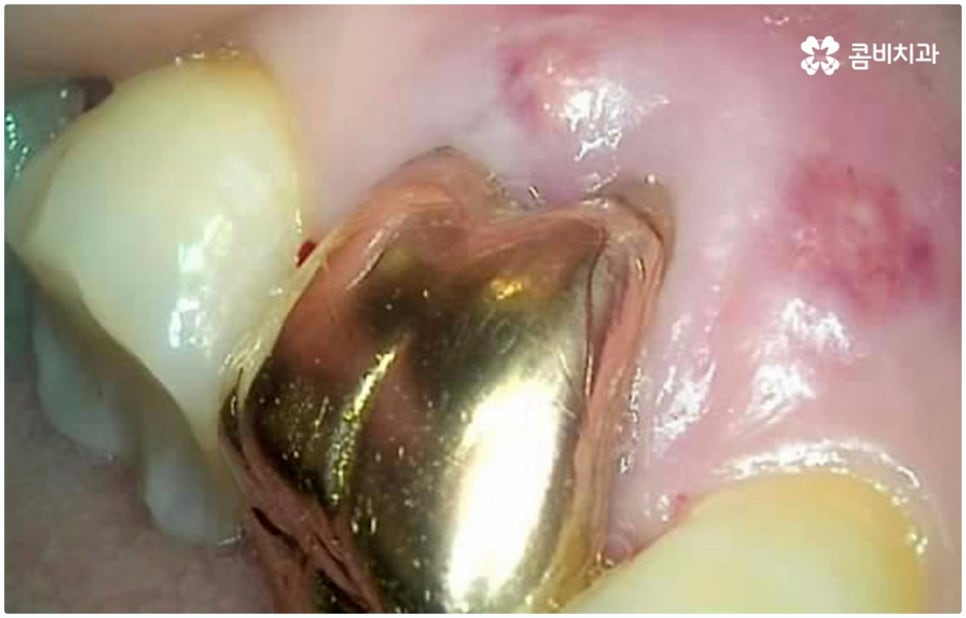 원데이임플란트 받고 싶으신가요? 관련 이미지 3