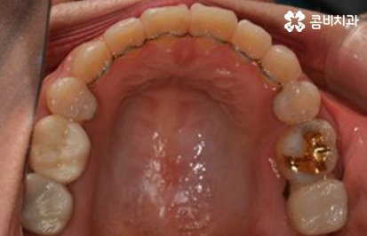 클리피씨교정 알아볼 때 꼭 신경 써야 하는 점은! 관련 이미지 13