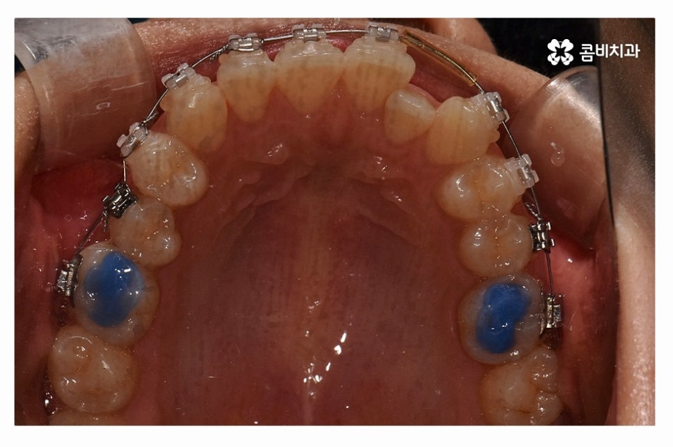 덧니교정 체계적으로 준비하려면 관련 이미지 7