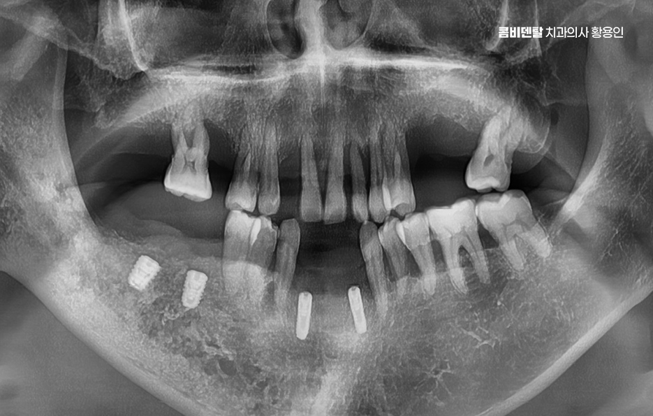 50대임플란트 꼼꼼하게 따져봐야할 포인트는 관련 이미지 3