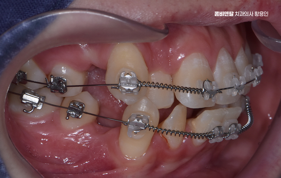 송곳니 덧니 발치 이럴때 해당되네요 관련 이미지 8