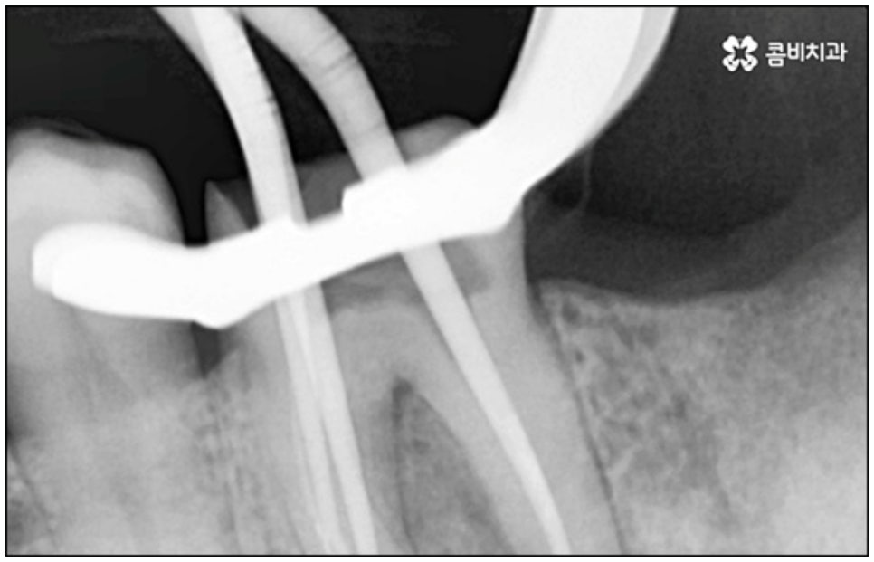 당일임플란트 나도 할수있나요 관련 이미지 14