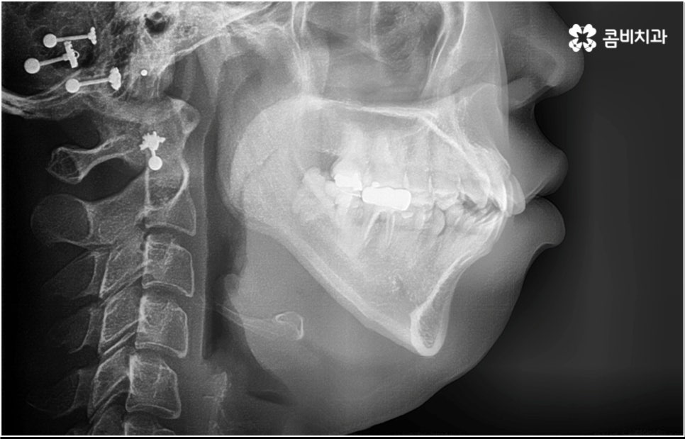 성인 치아교정 기간 걱정이 앞서나요 관련 이미지 1