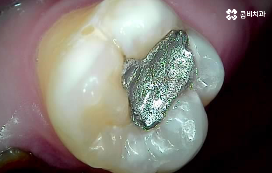 충치 신경치료 안하면 후회하는 이유 관련 이미지 7