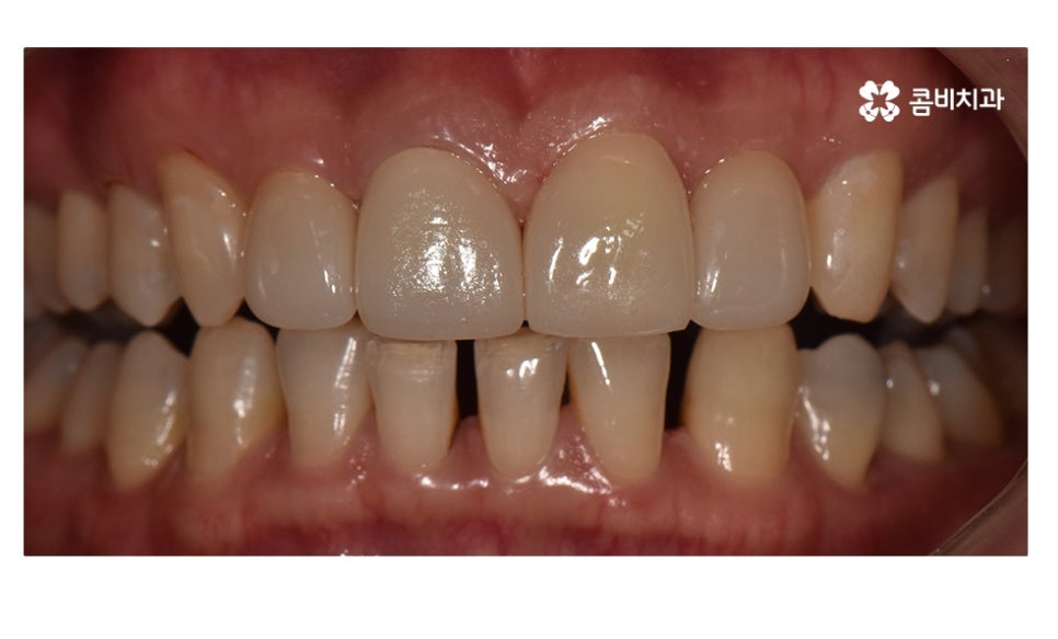 무삭제라미네이트 포인트부터 잘 알고 시작하려면 관련 이미지 6