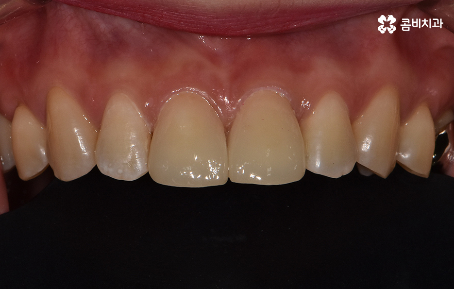 블랙트라이앵글 레진으로 해결한 사례 관련 이미지 6