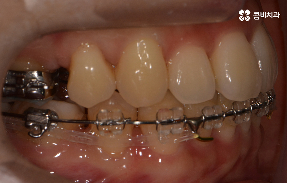 앞니치아교정 자연스러운 결과를 위해 알아둬야 할 점 관련 이미지 7