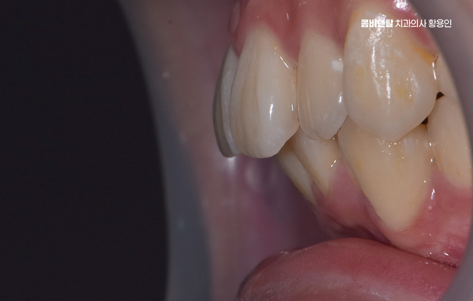 부정교합 교정 안하면 생기는 문제는 뭔가요 관련 이미지 4