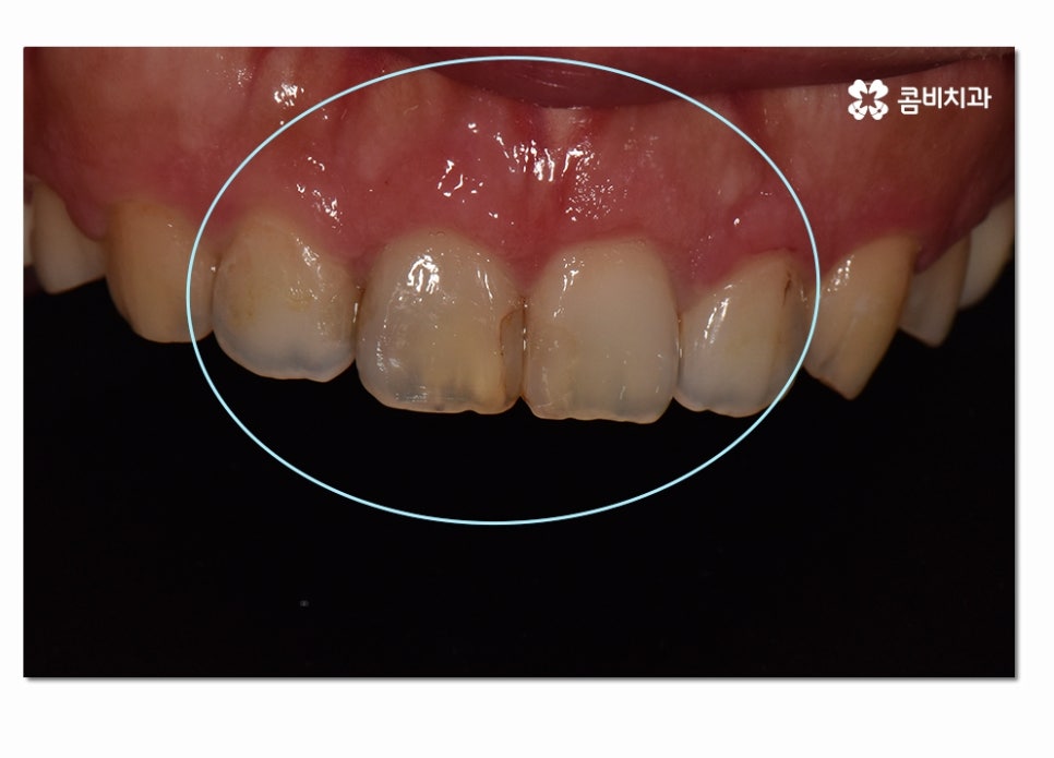 치주질환 치료의 중요성과 치은절제술이 활용된 사례 관련 이미지 6
