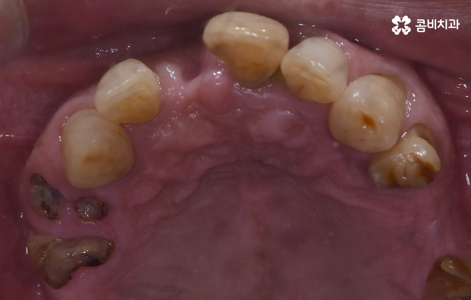 치주염 발치 이렇게나 심각하네요 관련 이미지 7