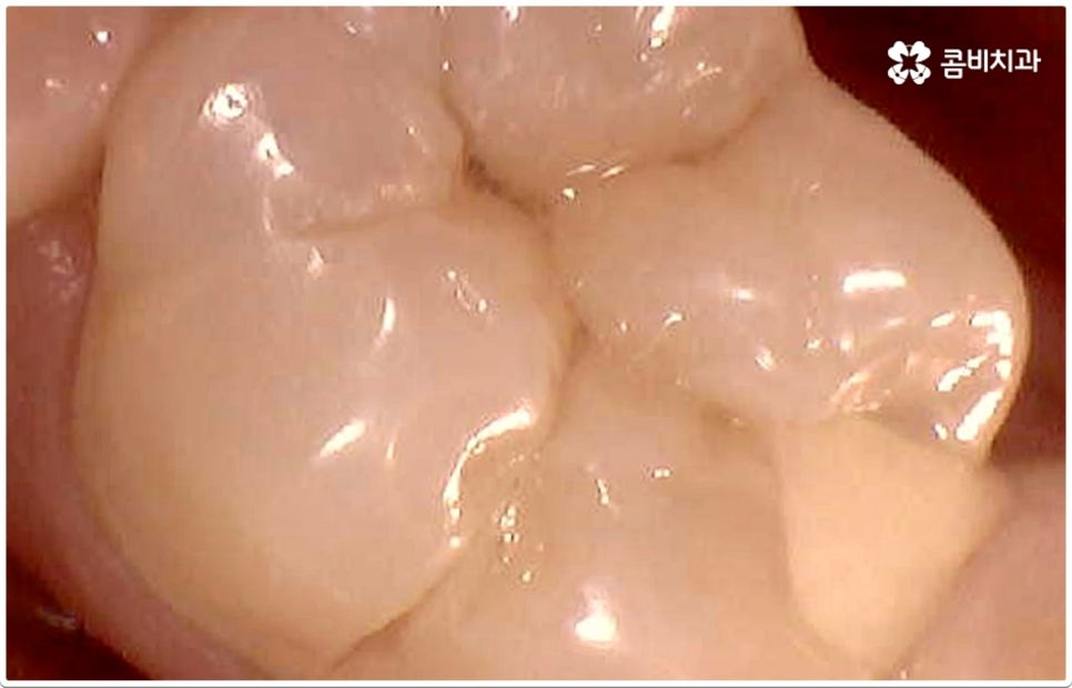 치아사이충치 놔두면 안돼요 관련 이미지 8