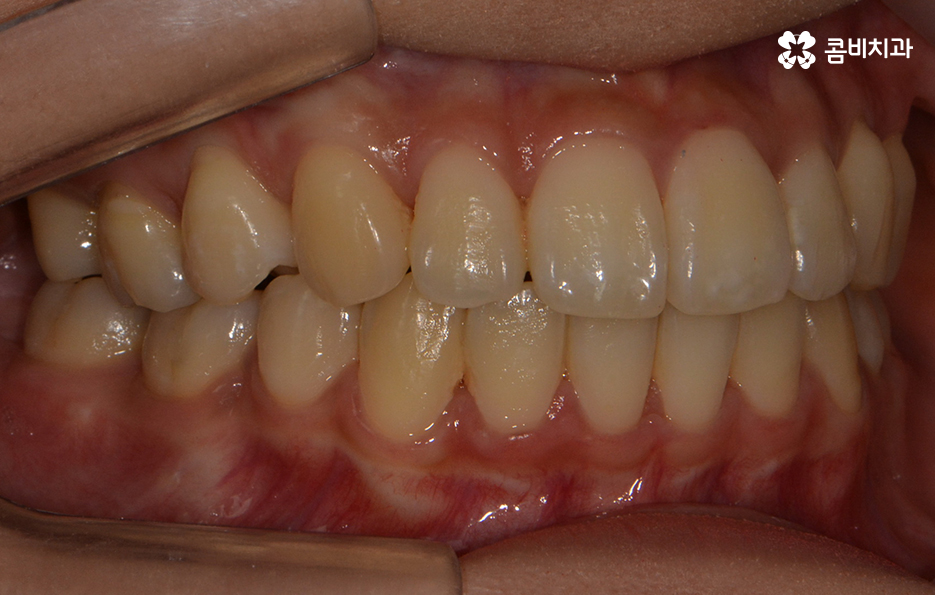 콤비교정 나에게 적합한지 판단하려면 관련 이미지 15