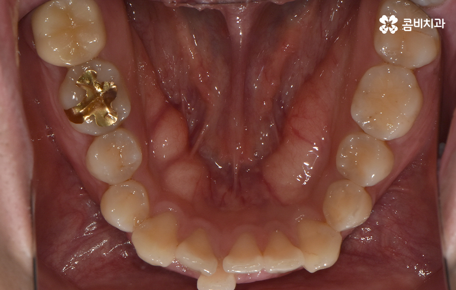 아랫니교정 이렇게만 파악하시면 됩니다 관련 이미지 5