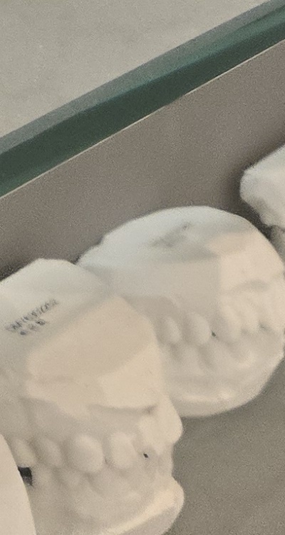 앞니 틀어짐 부분교정 얼마나 걸릴까 관련 이미지 47