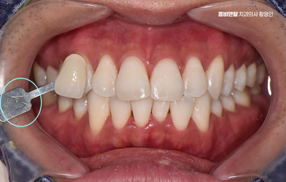 치과 치아미백 효과 어떤식으로 나타날까 관련 이미지 5