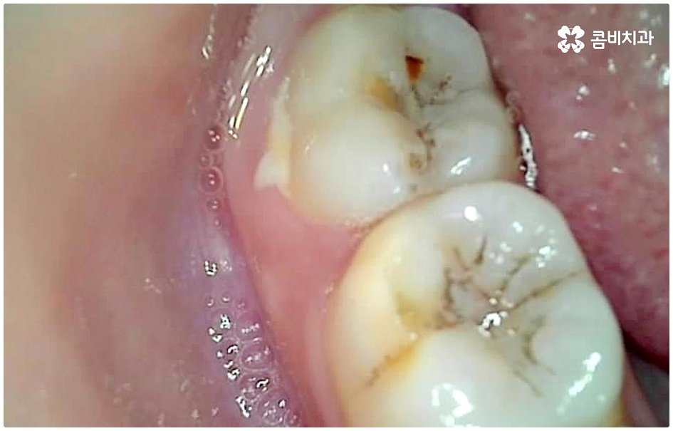 명동치과 평소에 케어하기 관련 이미지 6