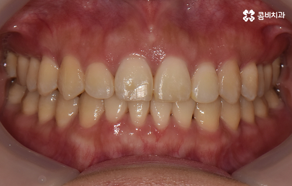 비발치치아교정 고민되는데 발치하면 안좋나요 관련 이미지 11