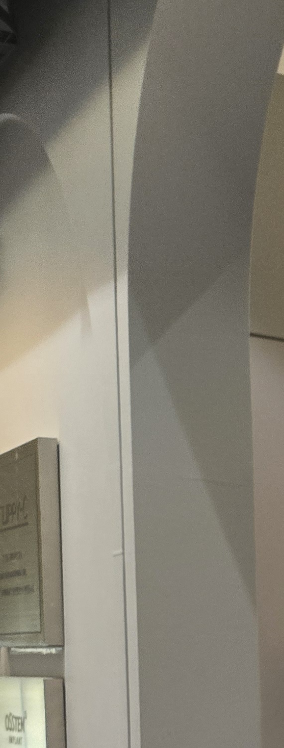 앞니 크라운 교체 깔끔하게 정리하려면 관련 이미지 29