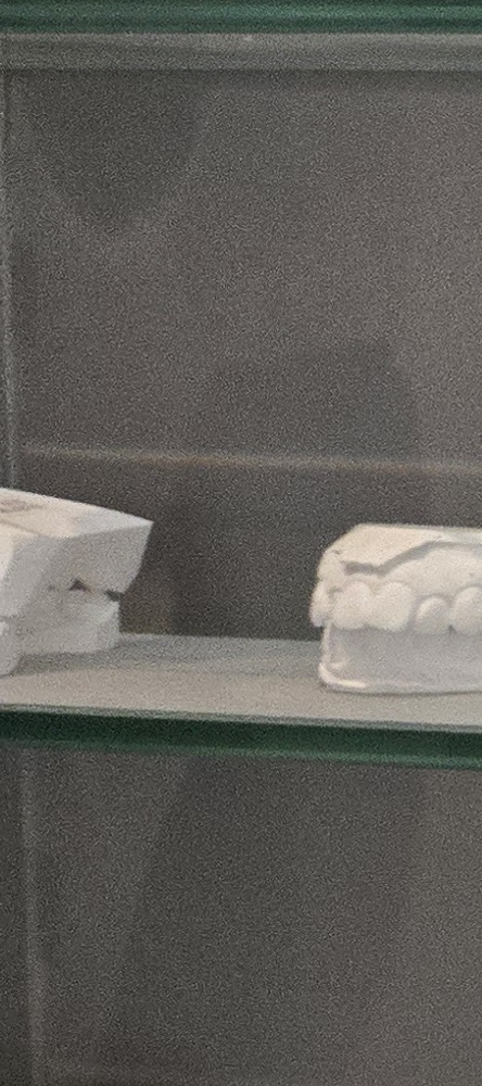 앞이빨 임플란트 과정 주의해야할 포인트는 관련 이미지 18