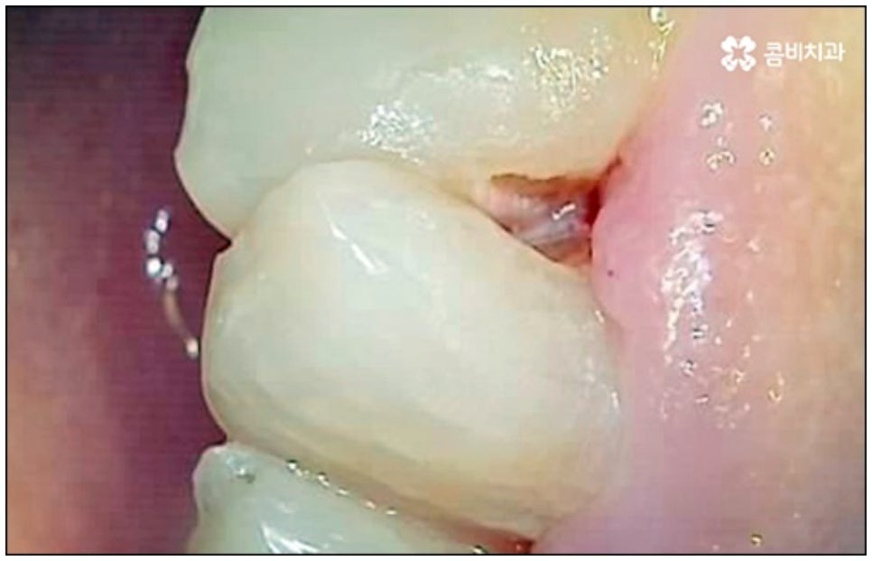 당일임플란트 나도 할수있나요 관련 이미지 4