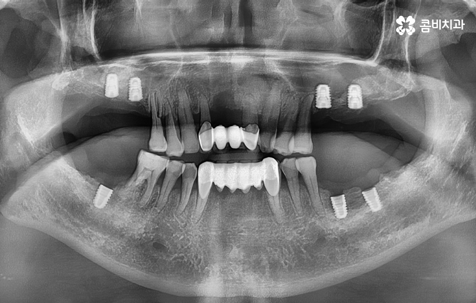 50대임플란트 각별하게 주의해야 하는 시기 관련 이미지 9