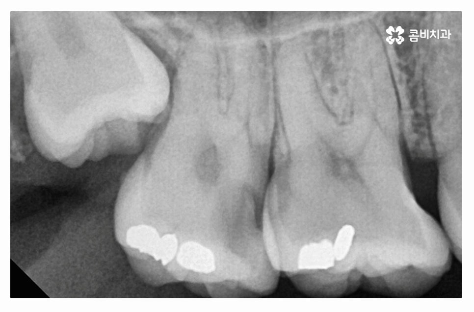 누운사랑니발치 언제 뽑을지 고민이라면 관련 이미지 5