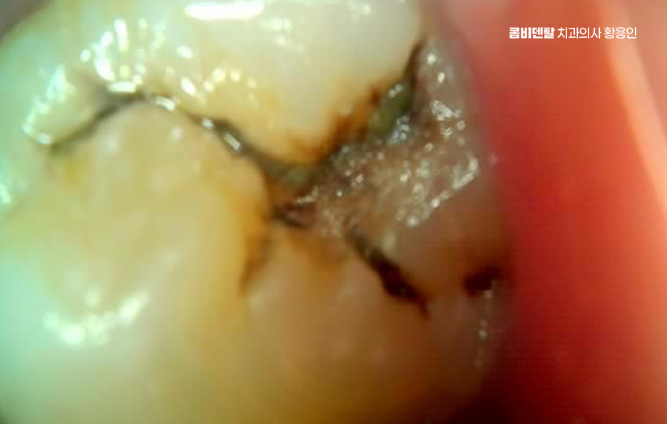 어금니 충치 단계 미리 알아차리려면 관련 이미지 2