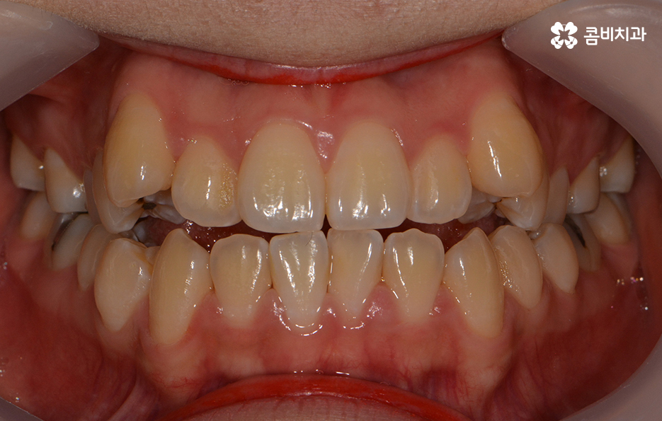송곳니 덧니 뽑지 않고 해결된 사례 관련 이미지 1