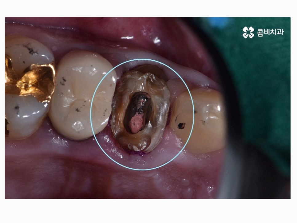 명동치과 누구나 놓치기 쉬운 문제점은! 관련 이미지 10