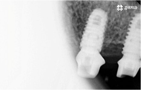 명동치과 타고난 이의 수명은 관련 이미지 12