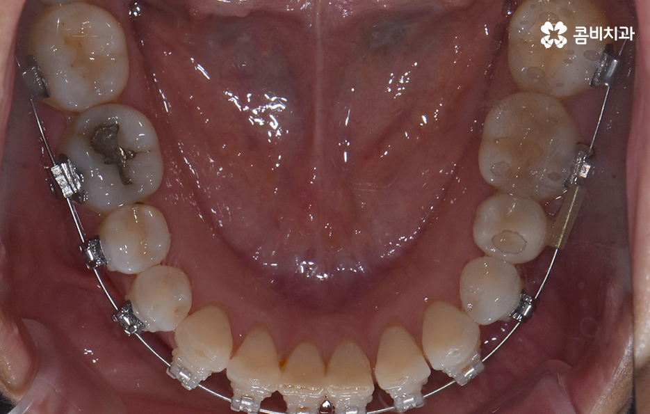 중년치아교정 이제라도 해도 될까요 관련 이미지 15
