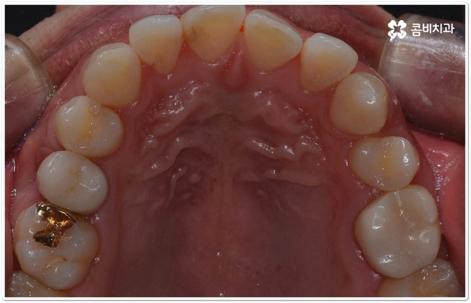 클리피씨교정 합리적인 초이스! 관련 이미지 4