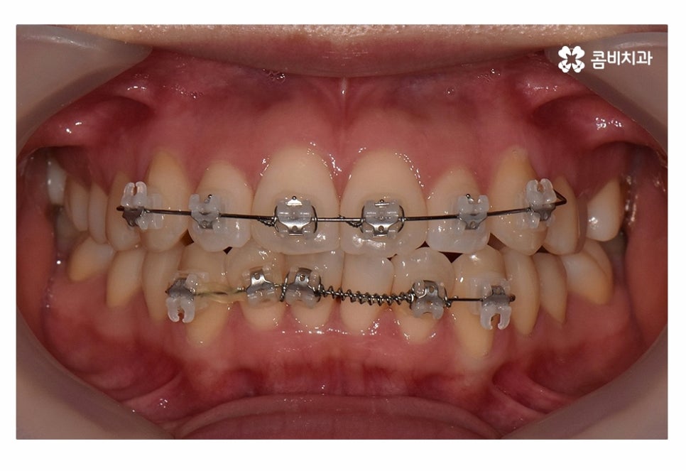 치아부분교정 나도 해당될지 궁금하다면 관련 이미지 8
