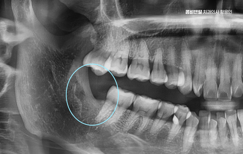 아래 사랑니 발치 통증 미리 알고 대처하려면 관련 이미지 7
