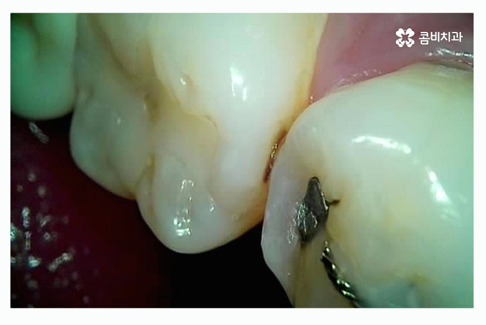 충치 레진 인레이 합리적으로 결정하려면 관련 이미지 3