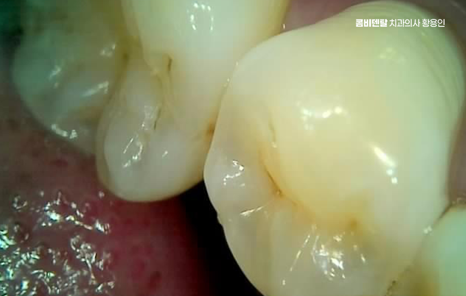 충치 검은점 나타났다면 이렇게 대처해요 관련 이미지 10
