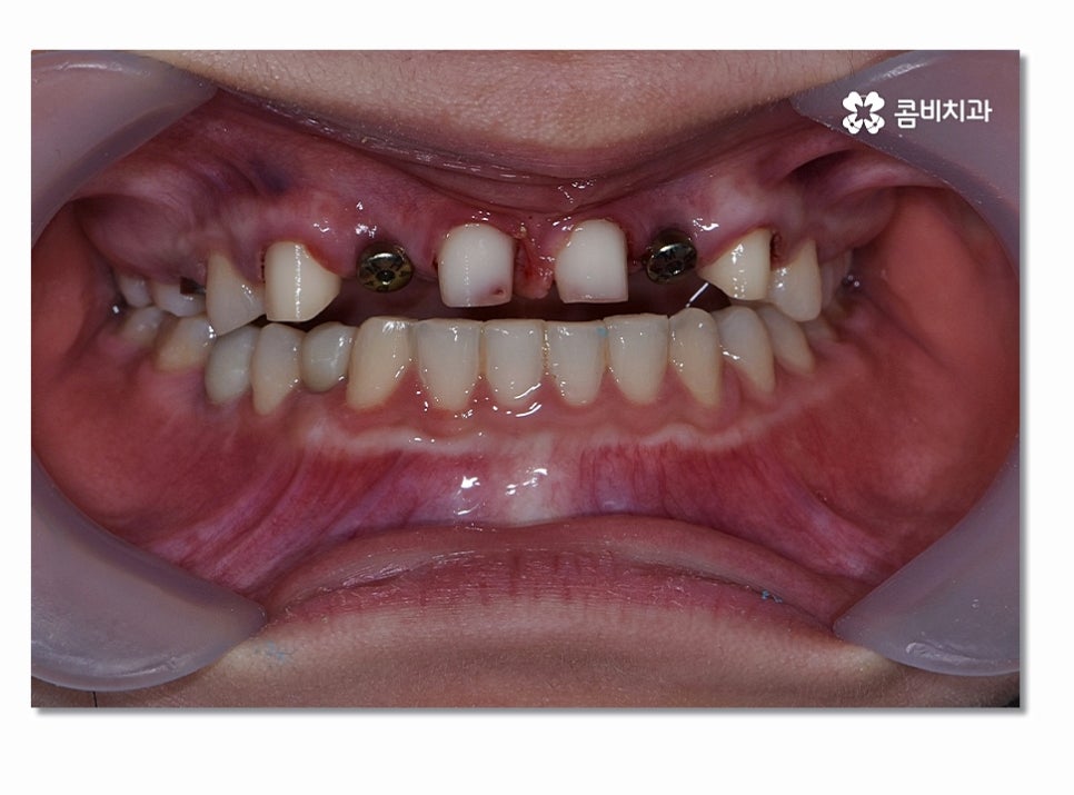 앞니임플란트 합리적으로 접근하려면 관련 이미지 4