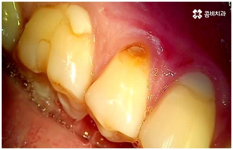 어금니충치치료 아프다면 빨리 관련 이미지 9