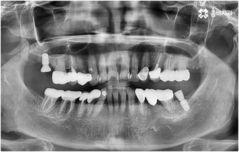어금니임플란트 살펴볼 사항들은 무엇인가요? 관련 이미지 7