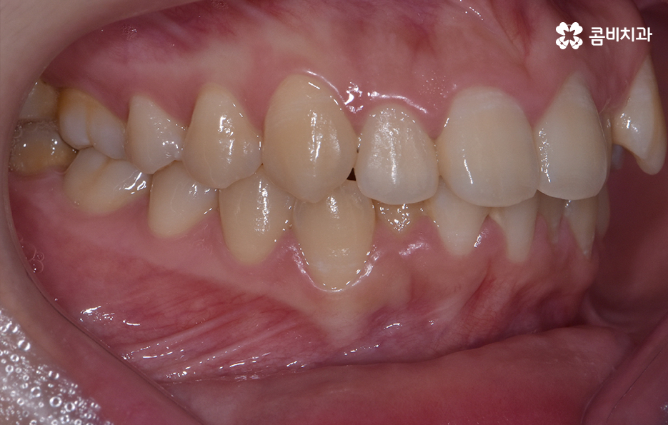 덧니 비발치 교정 자연스럽게 가능한 경우도 있어요 관련 이미지 3