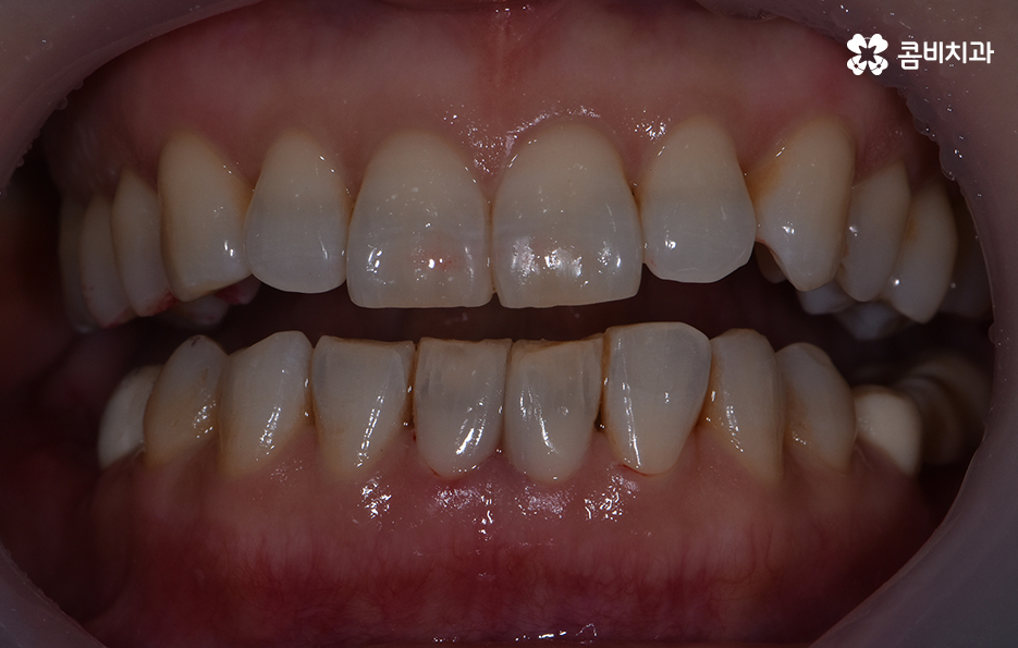 블랙트라이앵글 레진으로 해결한 사례 관련 이미지 3