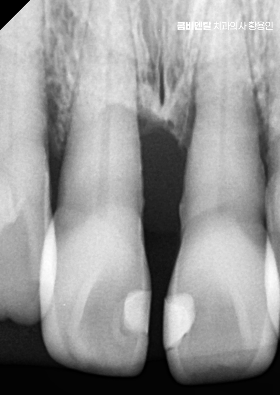 치아 사이 벌어짐 심해지는 이유부터 알아보면 관련 이미지 2