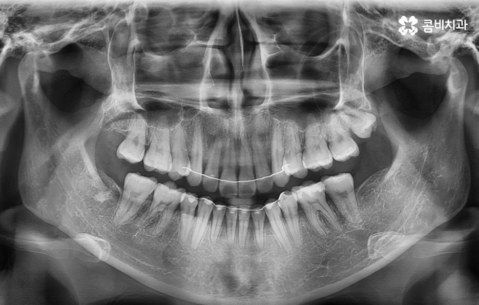 앞니치아교정 자연스러운 결과를 위해 알아둬야 할 점 관련 이미지 13